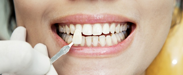 Applying Veneers to Front Teeth