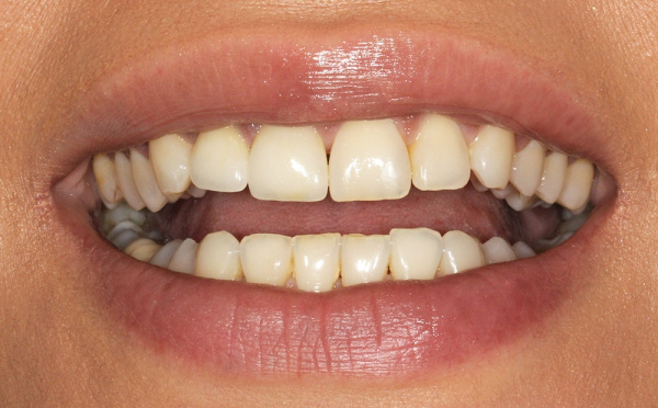 Correction of front teeth using crown and restoration