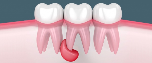 Dental cyst treatment