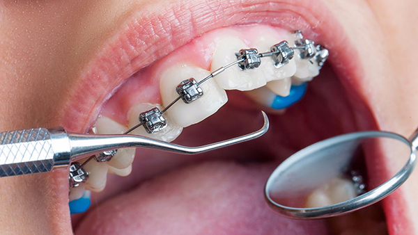 Can my teeth be treated with braces?