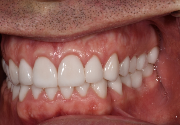 Comprehensive work: dental implantation and further prosthetics using E-max crowns