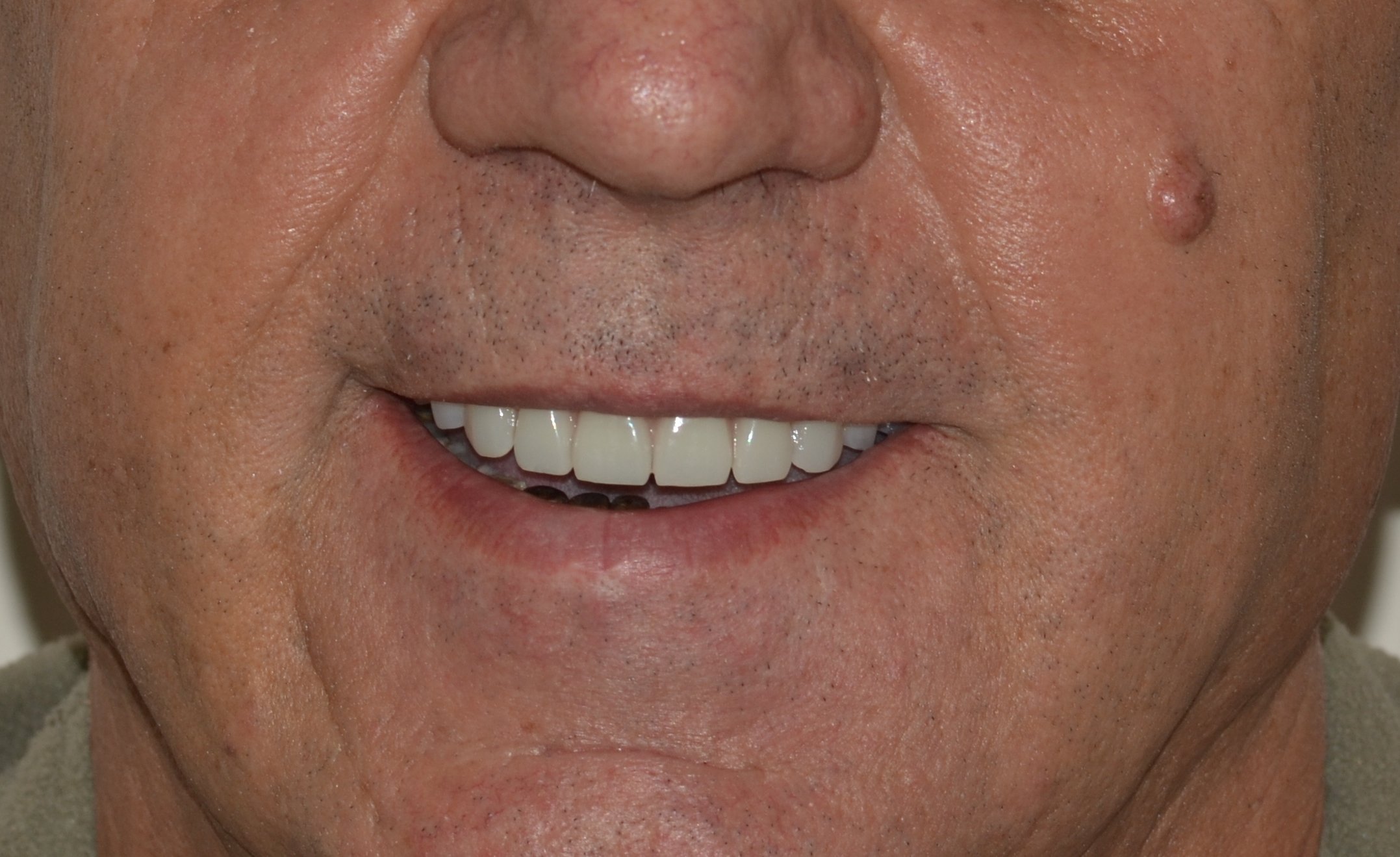Removing teeth on the upper jaw and installing four Nobel implants in the concept ‘ALL-ON-4’