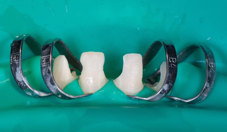 Restoration of 6 front teeth after orthodontic treatment with E-max