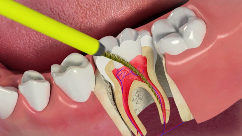 Modern filling of tooth canals
