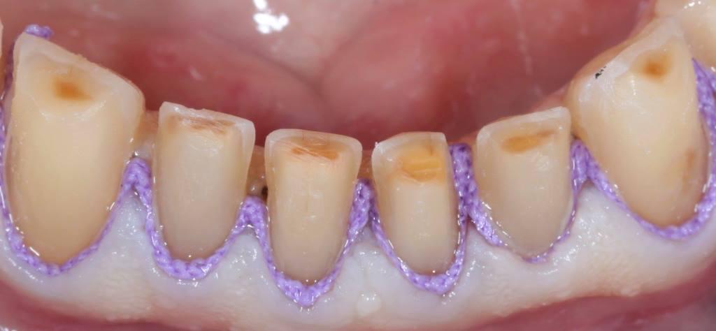 Total prosthetics of the upper and lower jaw of the patient with zirconia crowns on implants and E.max veneers