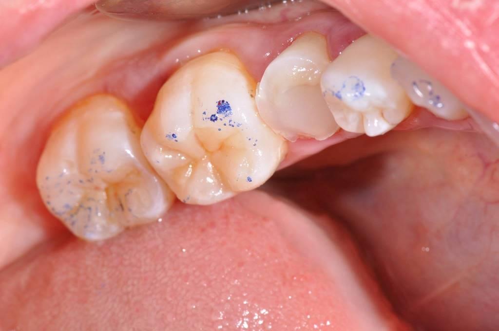 Caries treatment and replacement of the old filling with Emax ceramic overlay