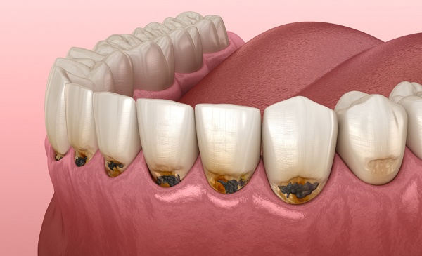 Treatment of dental caries
