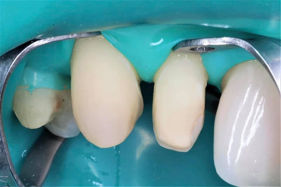Esthetic rehabilitation with veneers with pre-orthodontic preparation of the lower jaw