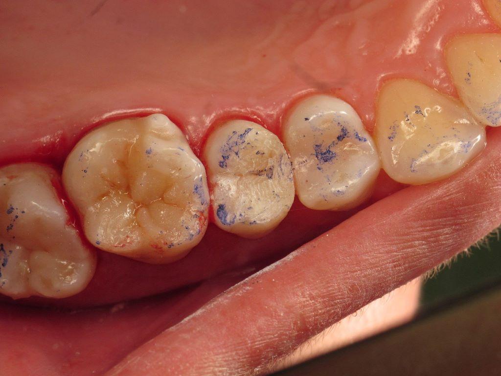 Caries treatment and replacement of fillings with Art restorations