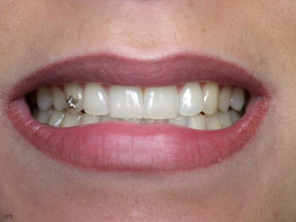 Dental jewelry (Skyce)