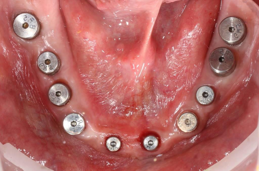 Total reconstruction of dentitions using metal-ceramic implant-supported fixed dental prostheses
