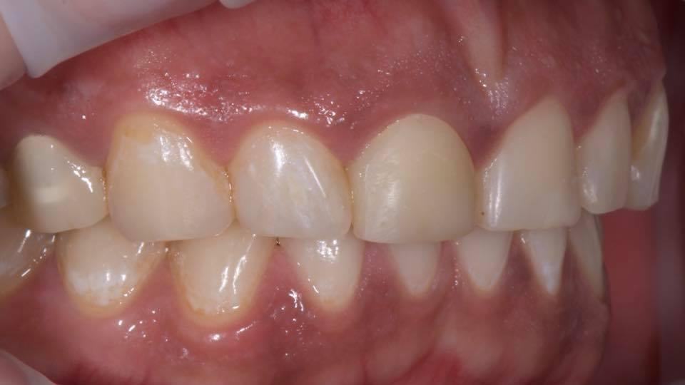 Aesthetic rehabilitation of front teeth