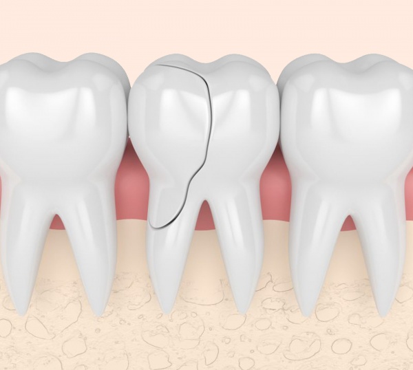 What should I do if I have a broken tooth?
