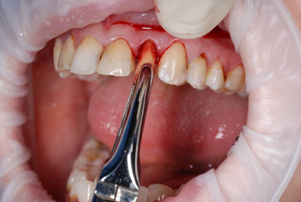 Tooth extraction with simultaneous implantation