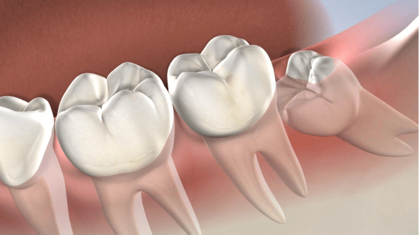 Wisdom tooth in pregnancy