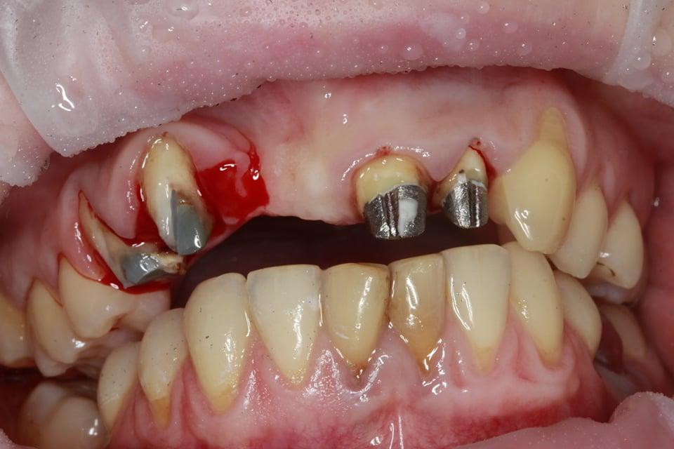 Replacing ceramic gums on human
