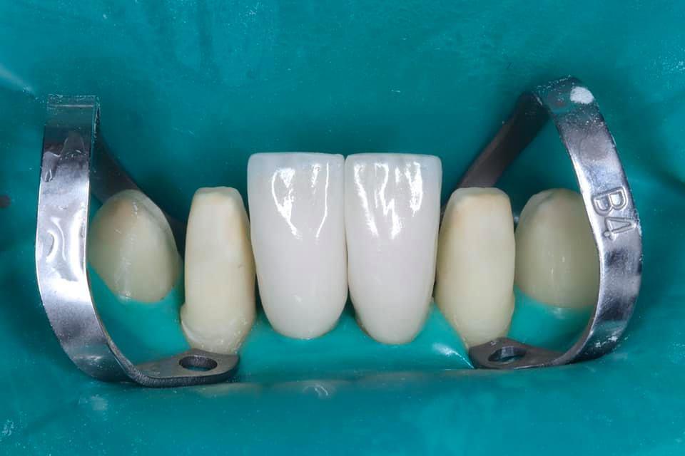 Esthetic rehabilitation with veneers with pre-orthodontic preparation of the lower jaw