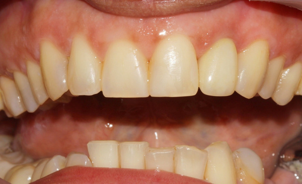 The restoration of front teeth using crown and composite material