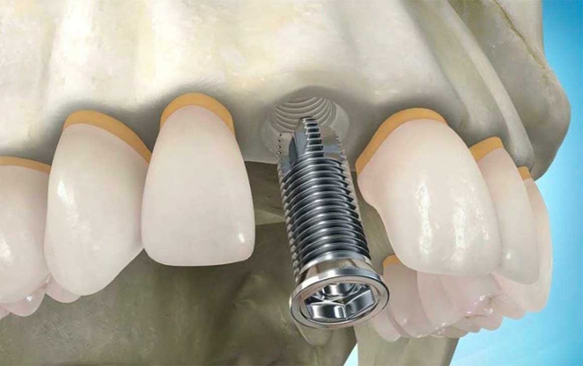 Do I need a dental implant if there is only one dental unit missing?