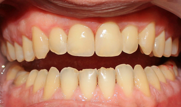 Aesthetic restoration of front teeth