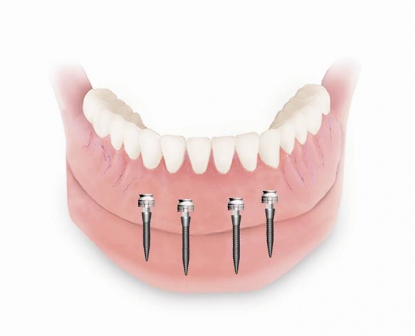 Implant-based removable dentures