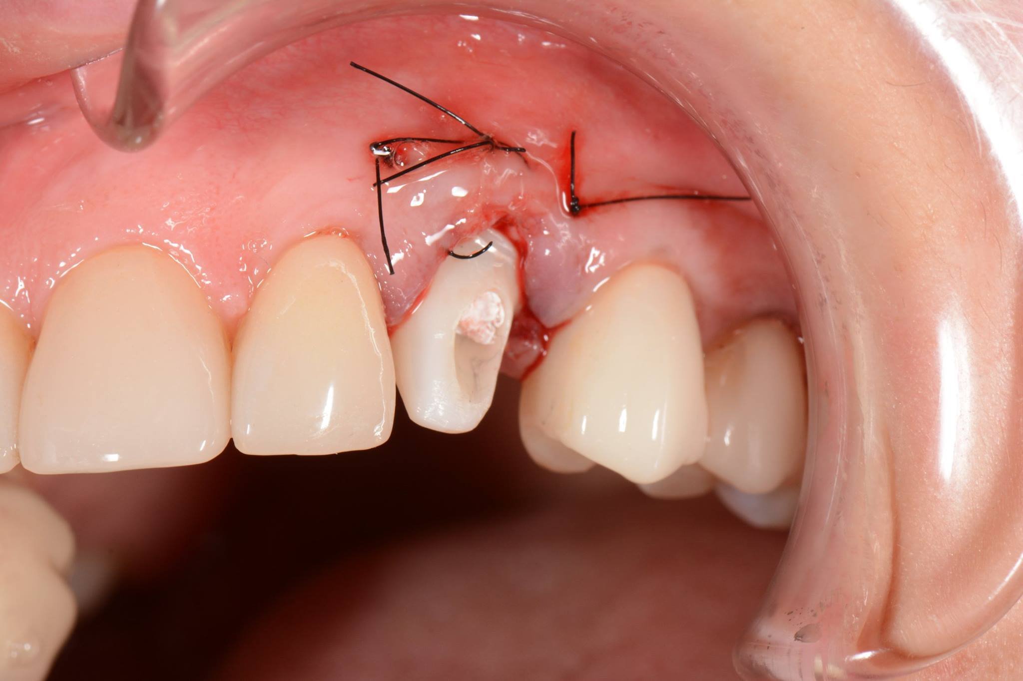 Dental implantation and tooth extraction