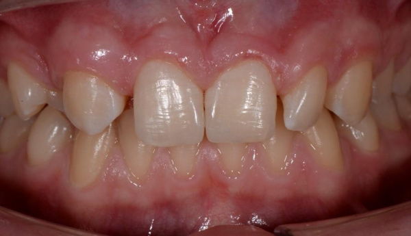 Traumatic chipped teeth of a 13-year-old child