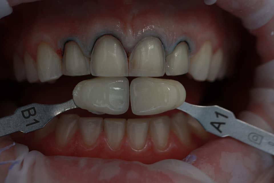 E-max veneers after orthodontic treatment