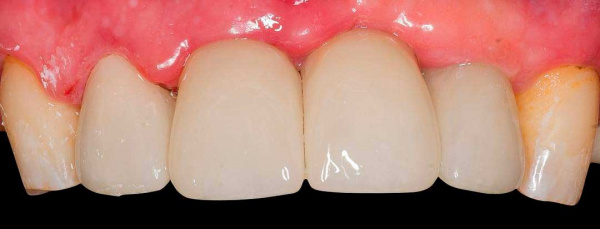 Ceramic crowns for frontal teeth rehabilitation