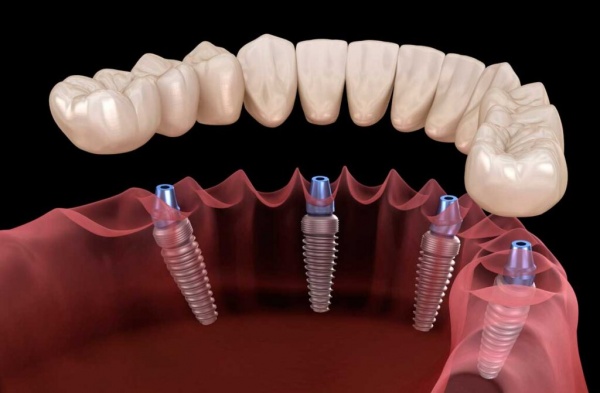 Is it possible to put 2 teeth on 1 implant