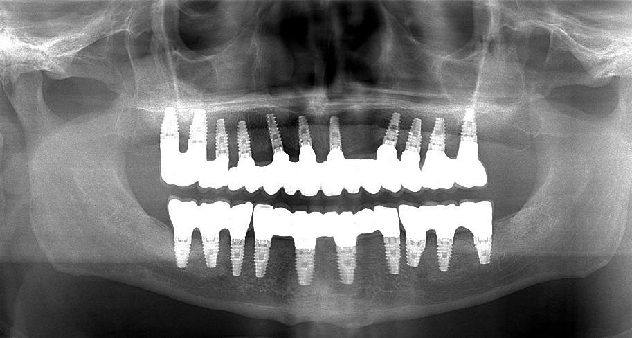 Total reconstruction of dentitions using metal-ceramic implant-supported fixed dental prostheses