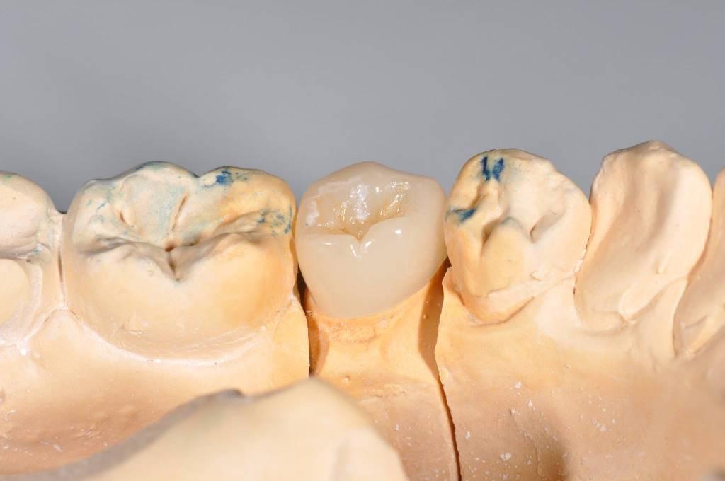 Caries treatment and replacement of the old filling with Emax ceramic overlay
