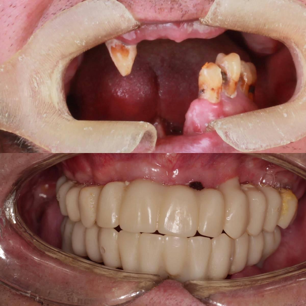 Reconstruction of the lower jaw using a fibular autograft with dental implantation and immediate crown loading