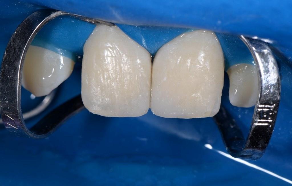 Traumatic chipped teeth of a 13-year-old child