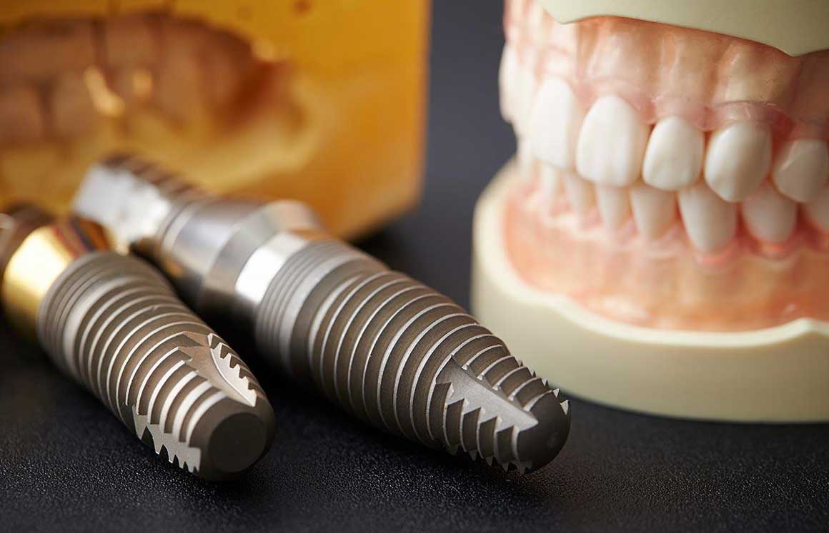 Survival of dental implants