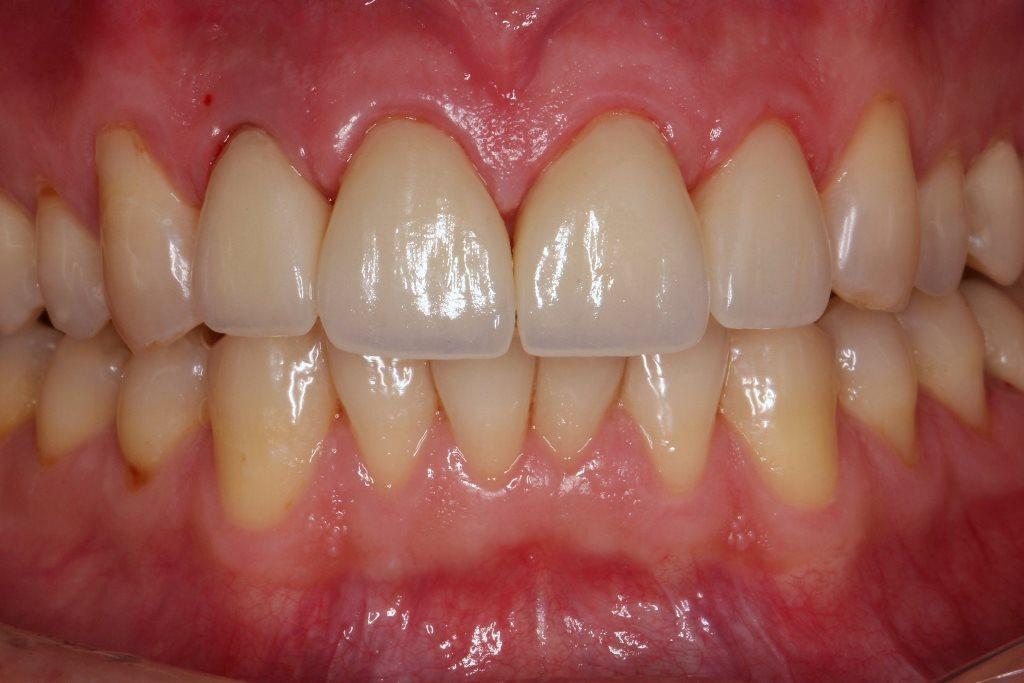 Aesthetic smile rehabilitation with lithium disilicate ceramic restorations