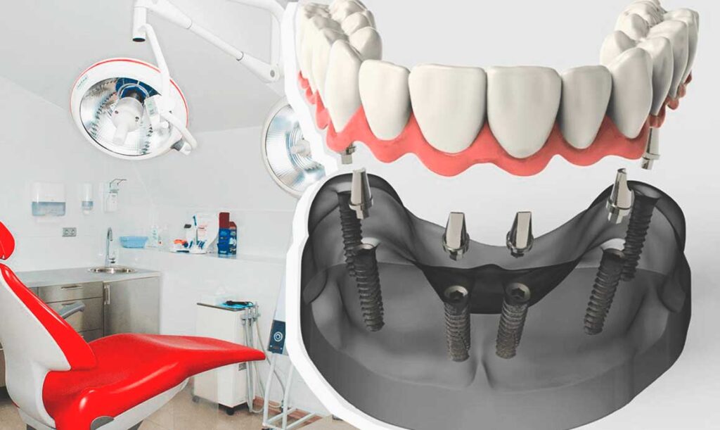 Classical or basal implantation of teeth