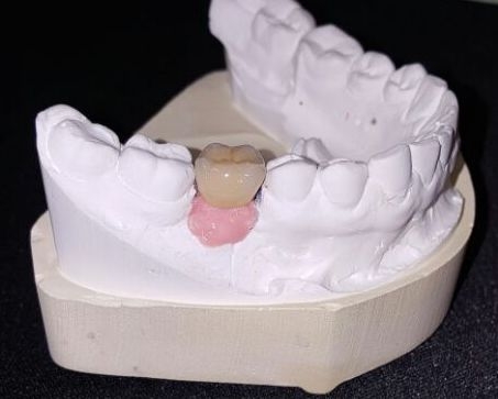Single-tooth implant restoration