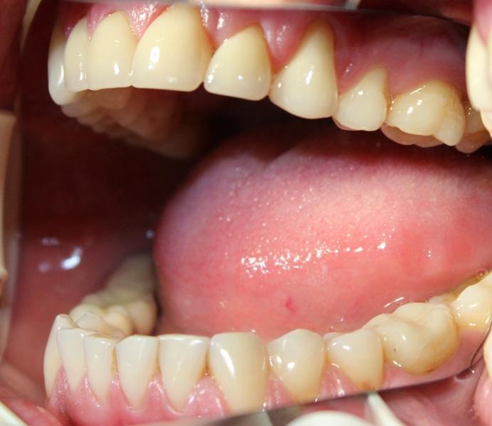 Aesthetic and functional rehabilitation of upper jaw teeth using ceramic restorations