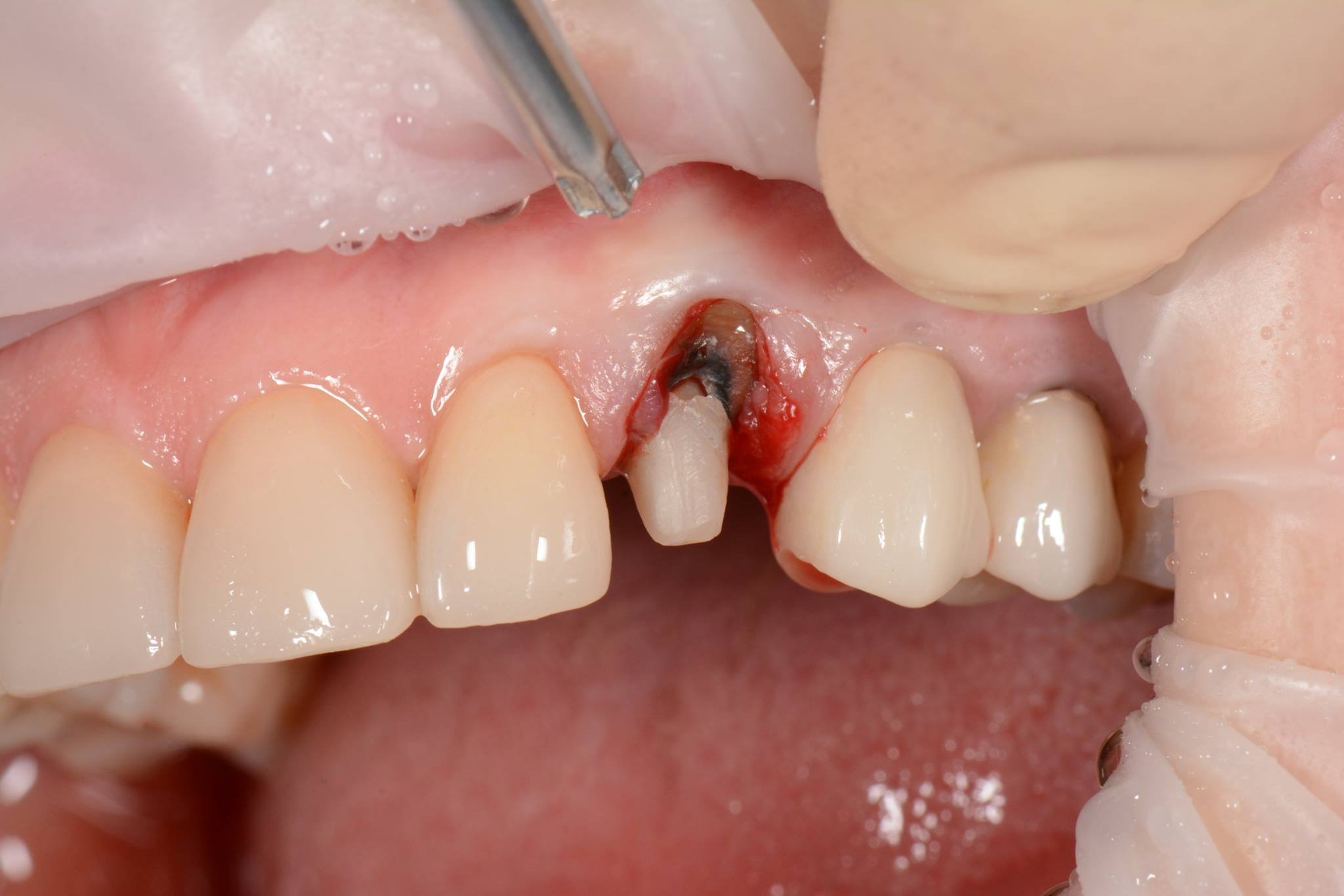Dental implantation and tooth extraction