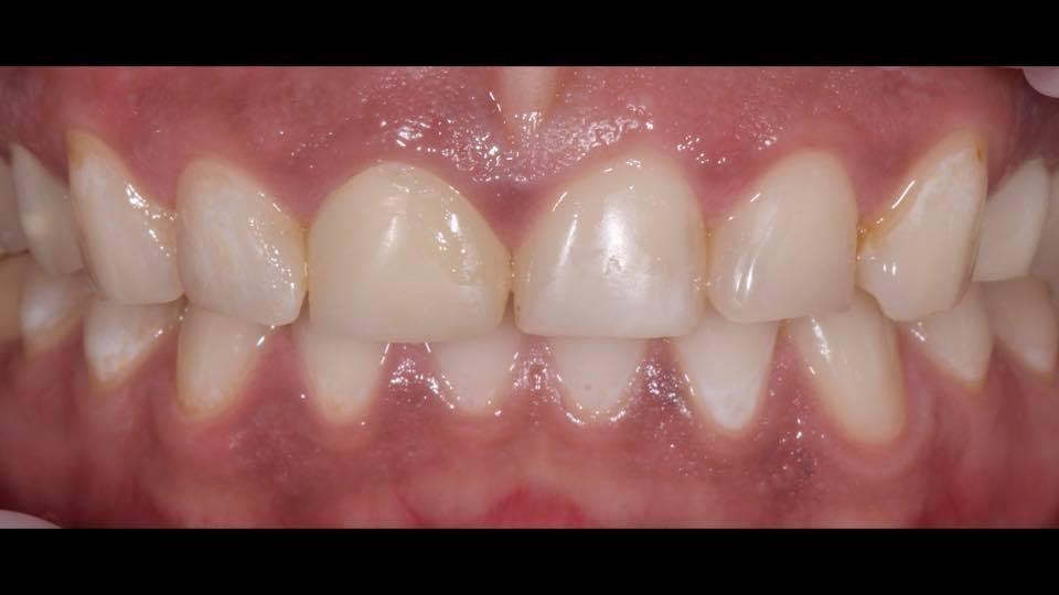 Aesthetic rehabilitation of front teeth