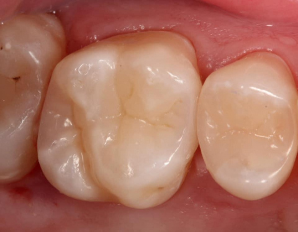Treatment of dental caries: tooth number 16
