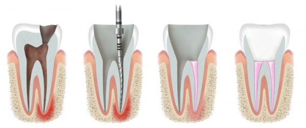 Dental Canal Treatment