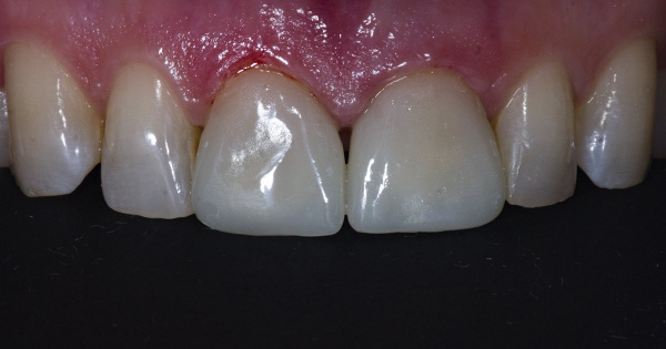 The patient applied to the dental clinic to improve the aesthetic of two front teeth
