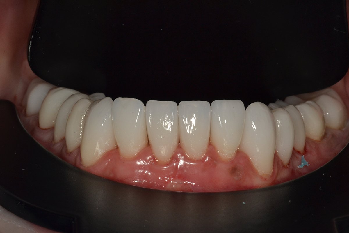 Comprehensive rehabilitation ‘ALL ON 28’ - installation of 28 ceramic crowns