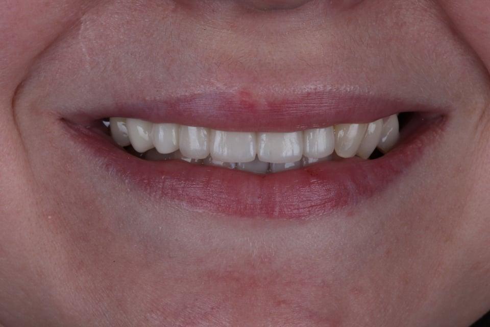 Replacing ceramic gums on human
