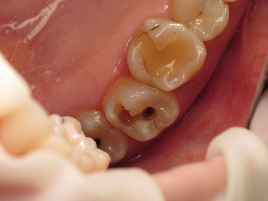 Caries treatment and replacement of fillings with Art restorations