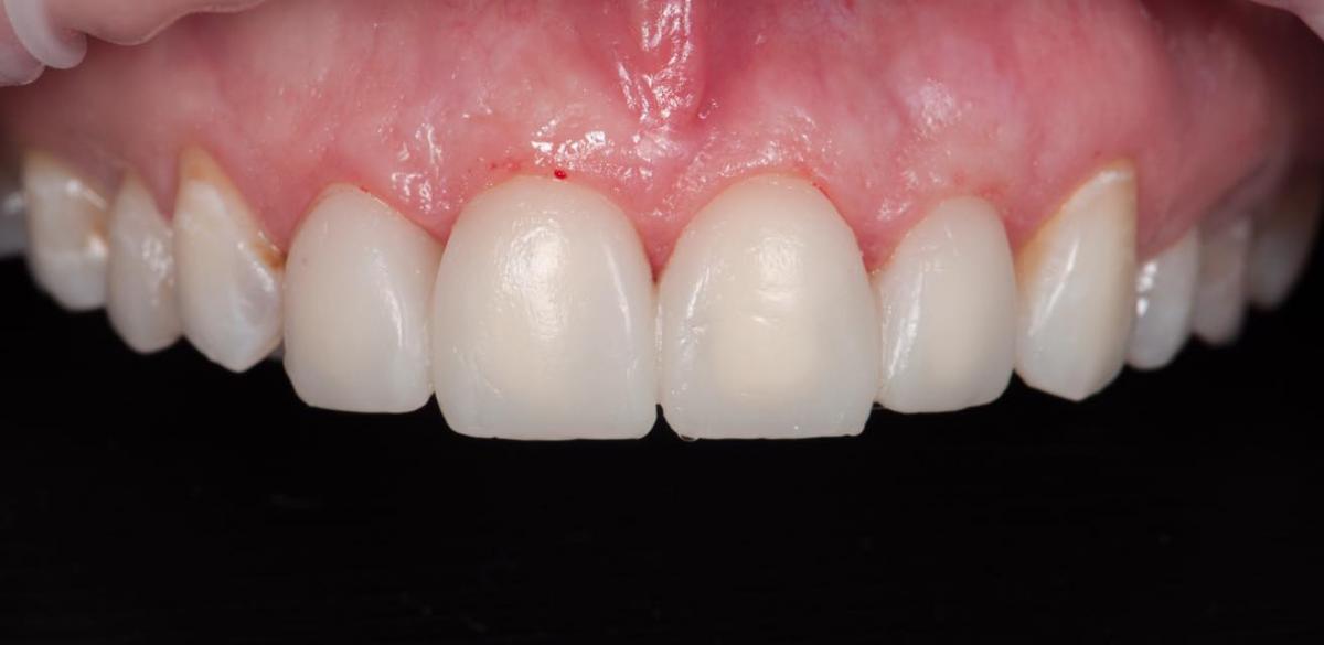 Restoration of 6 front teeth after orthodontic treatment with E-max