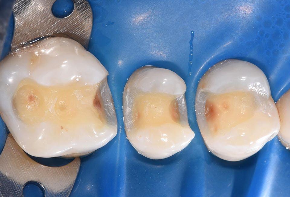 Treatment of dental caries by a direct method using modern composite materials