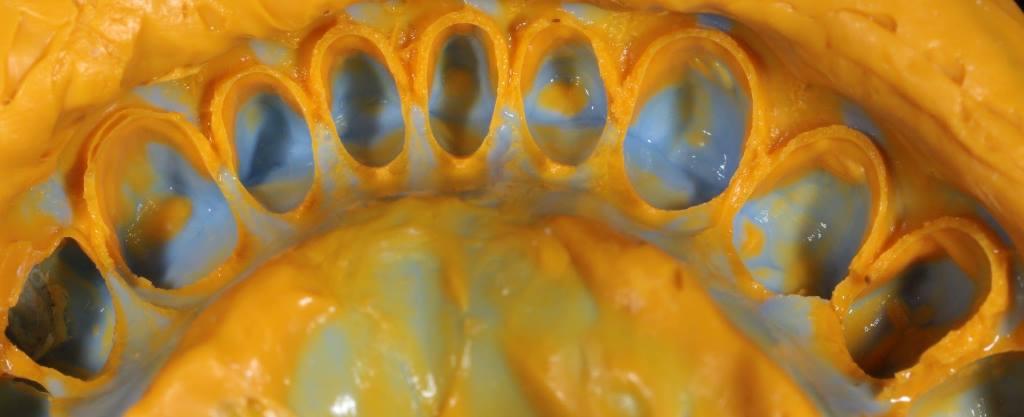 Total prosthetics of the upper and lower jaw of the patient with zirconia crowns on implants and E.max veneers